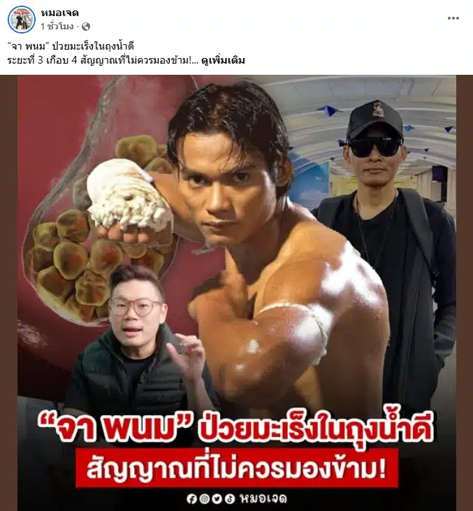 หมอเจด โพสต์เตือนภัยมะเร็งในถุงน้ำดี