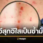 จริงหรือ อีสุกอีใส เป็นแล้วตอนเด็ก ไม่เป็นซ้ำอีก หลังระบาดหนัก ติดเชื้อหลักหมื่น