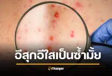 จริงหรือ อีสุกอีใส เป็นแล้วตอนเด็ก ไม่เป็นซ้ำอีก หลังระบาดหนัก ติดเชื้อหลักหมื่น