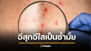 จริงหรือ อีสุกอีใส เป็นแล้วตอนเด็ก ไม่เป็นซ้ำอีก หลังระบาดหนัก ติดเชื้อหลักหมื่น