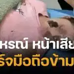 อุทาหรณ์ สาวชาร์จมือถือไว้ข้างหมอน บึ้มสนั่นกลางดึก ตื่นมาเสียโฉม ไฟครอกหนักกว่า 70%