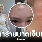 ฮยอนจอง Rolling Quartz โดนคนแปลกหน้าทำร้ายกลางถนน