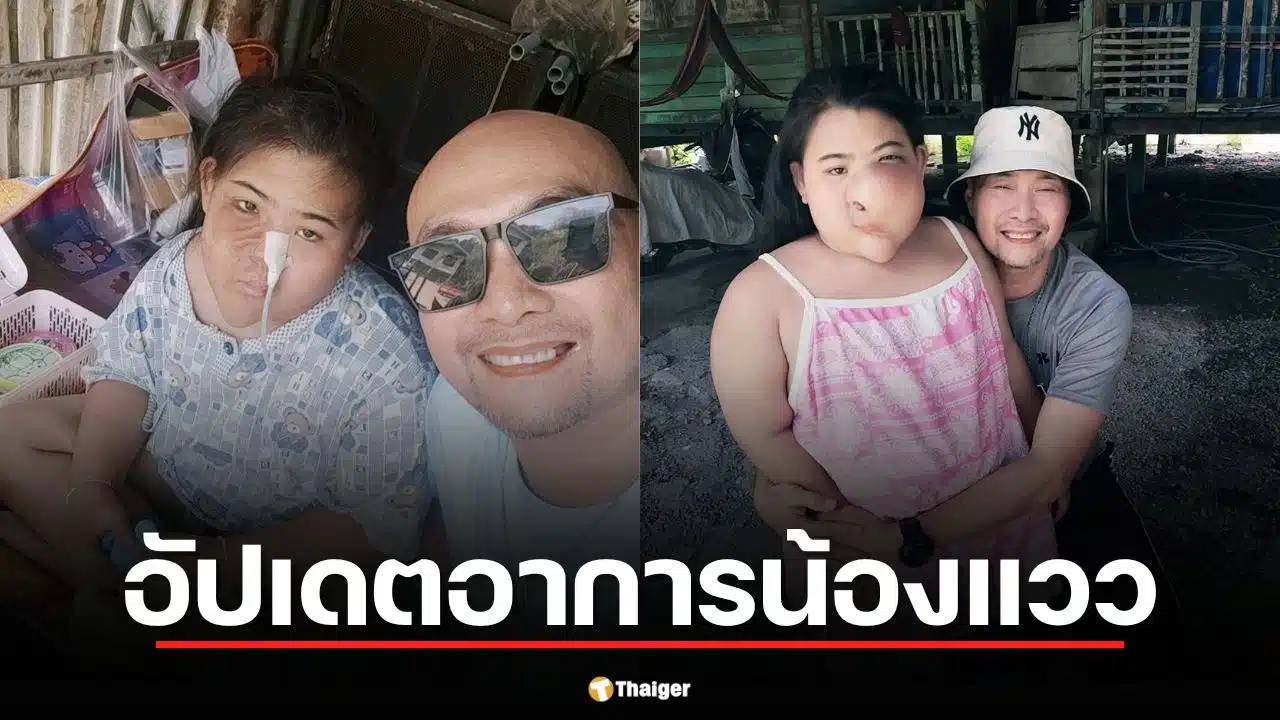 อี๊ด เชิญยิ้ม อัปเดตอาการ "น้องแวว" หลังผ่าตัดกระดูกใบหน้าผิดรูป เตรียมศัลยกรรมเพิ่ม