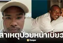 รัศมีแข ป่วยต่อมน้ำลายอักเสบหน้าเบี้ยว