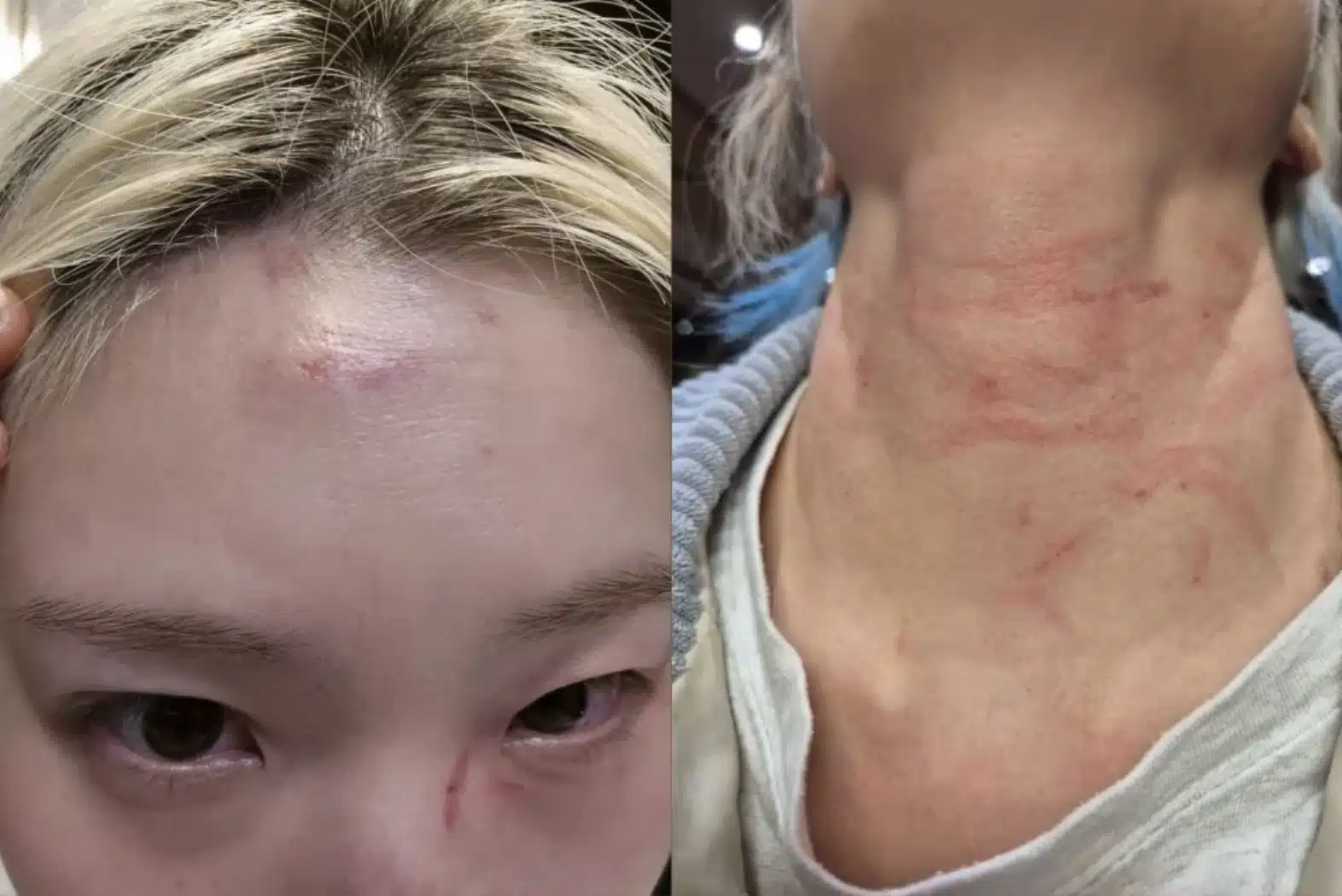 ชเว ฮยอนจอง Rolling Quartz ถูกคนแปลกหน้าทำร้าย