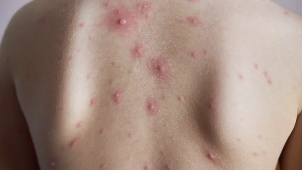 อีสุกอีใสระบาด เฝ้าระวังคลัสเตอร์สถานศึกษาปทุมธานี จริงหรือ เป็นแล้วตอนเด็ก ไม่เป็นซ้ำอีก 