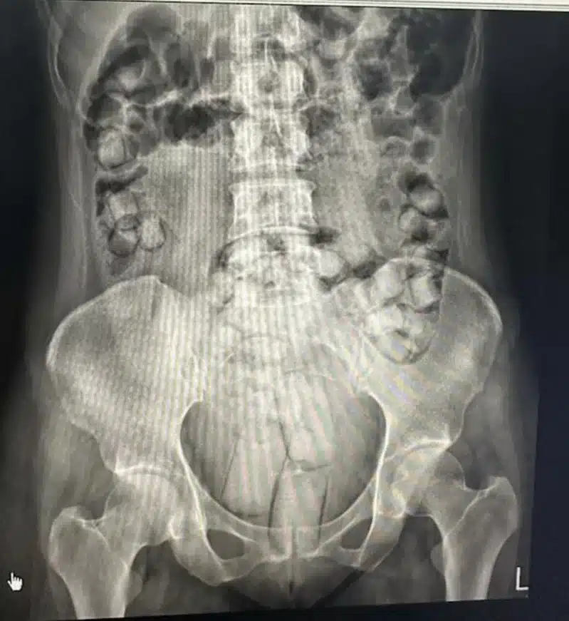 ภาพเอ็กซเรย์ช่องท้องเห็นก้อนยาเสพติดจำนวนมาก