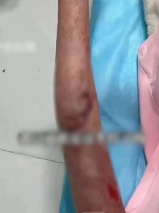 อุทาหรณ์ สาวชาร์จมือถือไว้ข้างหมอน บึ้มสนั่นกลางดึก ตื่นมาเสียโฉม ไฟครอกหนักกว่า 70%-3