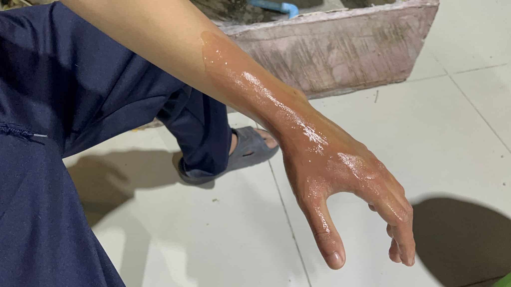 อุทาหรณ์! ไม้ตียุงไฟฟ้า ไม่มี มอก. ระเบิดใส่หน้า-แขน วัยรุ่นพานทองเจ็บหนัก-1