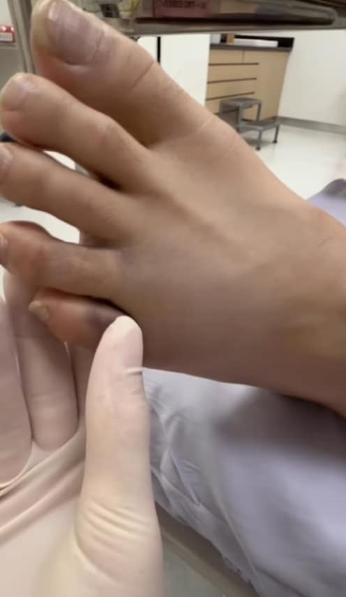 เอ ศุภชัย ลื่นล้มที่น้ำตก อัปเดตอาการล่าสุดนิ้วเท้าหัก 2 นิ้ว-4