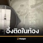 หนุ่มจีนปวดท้องหนัก หมอผงะ เจอปรอทวัดไข้ค้างในลำไส้นาน 20 ปี