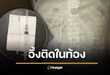หนุ่มจีนปวดท้องหนัก หมอผงะ เจอปรอทวัดไข้ค้างในลำไส้นาน 20 ปี