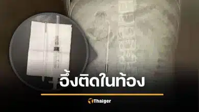 หนุ่มจีนปวดท้องหนัก หมอผงะ เจอปรอทวัดไข้ค้างในลำไส้นาน 20 ปี