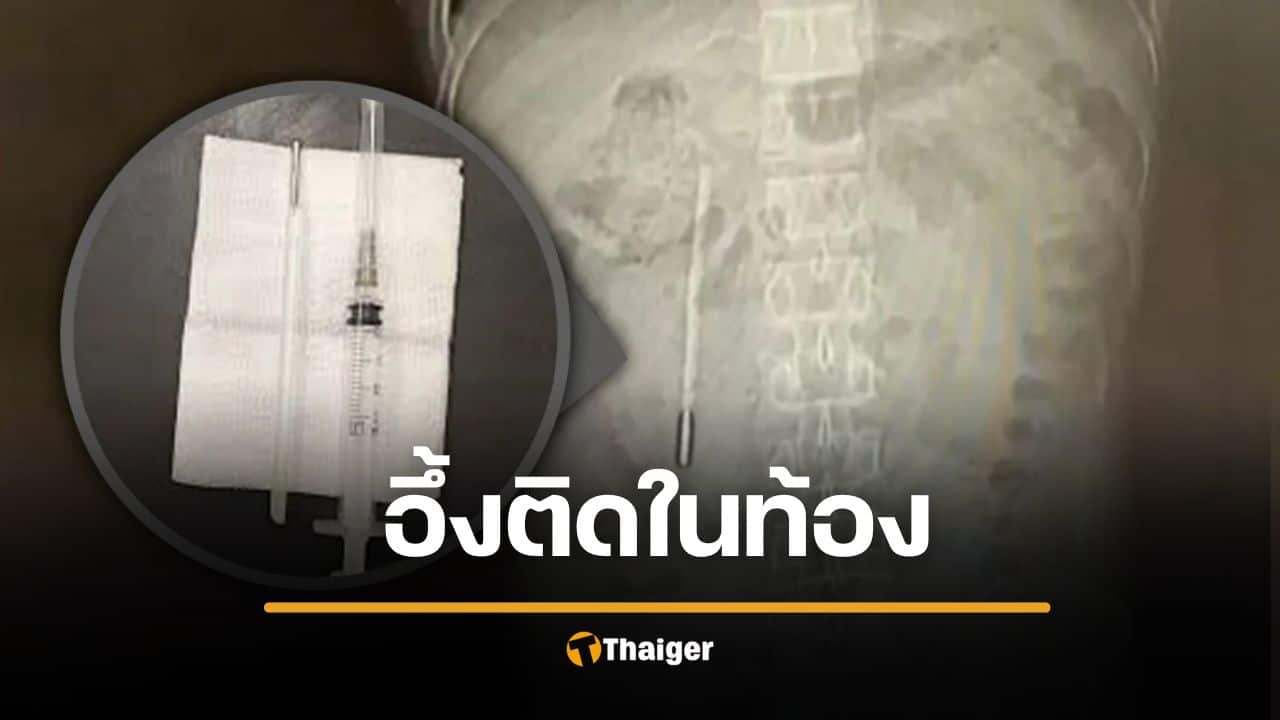 หนุ่มจีนปวดท้องหนัก หมอผงะ เจอปรอทวัดไข้ค้างในลำไส้นาน 20 ปี