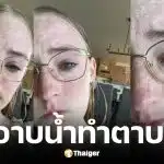 สาวเล่าอุทาหรณ์ตาขวาบอดสนิทเพราะใส่คอนแทคเลนส์อาบน้ำจนติดเชื้อป