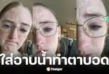 สาวเล่าอุทาหรณ์ตาขวาบอดสนิทเพราะใส่คอนแทคเลนส์อาบน้ำจนติดเชื้อป