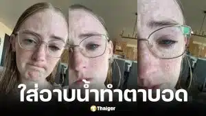 สาวเล่าอุทาหรณ์ตาขวาบอดสนิทเพราะใส่คอนแทคเลนส์อาบน้ำจนติดเชื้อป