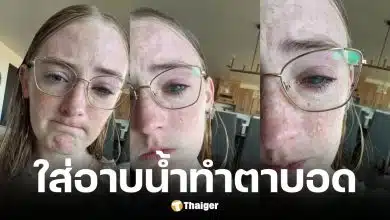 สาวเล่าอุทาหรณ์ตาขวาบอดสนิทเพราะใส่คอนแทคเลนส์อาบน้ำจนติดเชื้อป