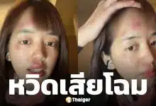 พลอย Pigkaploy หน้าเป็นแผลเหวอะ หลังจบทริปแอนตาร์กติกา ทำแฟนๆ ห่วงหนัก