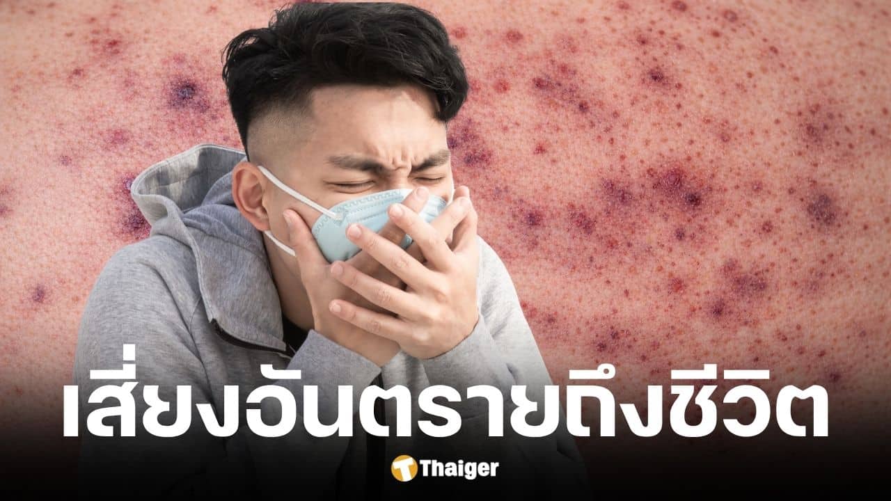 สสส. เตือนโรคไข้กาฬหลังแอ่นรุนแรงถึงขั้นเสียชีวิตได้ใน 24 ชม.