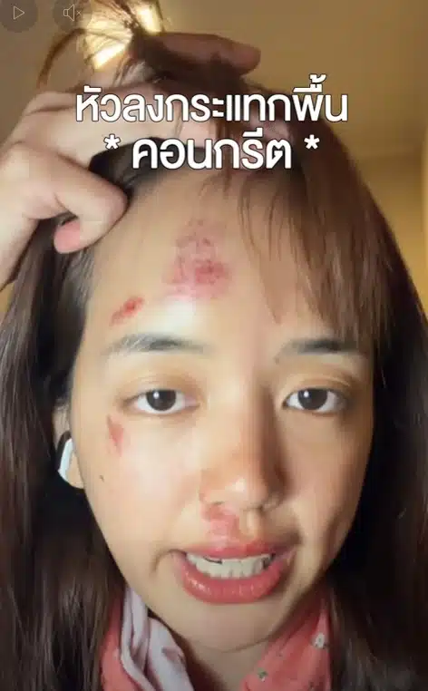 พลอย Pigkaploy หน้าเป็นแผลเหวอะ หลังจบทริปแอนตาร์กติกา ทำแฟนๆ ห่วงหนัก-3