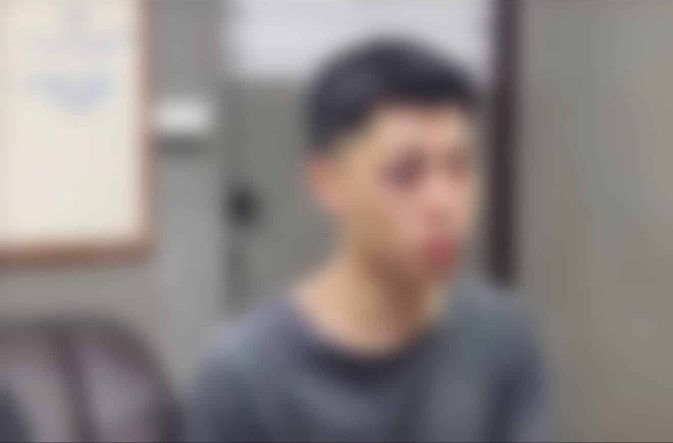 สภาพบาดแผลบริเวณดวงตาของหนุ่มเชียงใหม่ที่ถูกทำร้ายร่างกาย