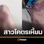 สาว 19 เหี้ยม สาดน้ำกรดแฟนเก่าเหวอะ ไม่ยอมคืนดี โพสต์เย้ย "อย่าเพิ่งตาย" พี่สาววอนขอความเป็นธรรมคดีไม่คืบ
