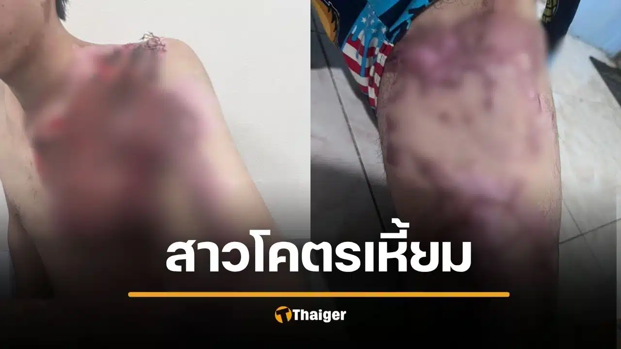 สาว 19 เหี้ยม สาดน้ำกรดแฟนเก่าเหวอะ ไม่ยอมคืนดี โพสต์เย้ย "อย่าเพิ่งตาย" พี่สาววอนขอความเป็นธรรมคดีไม่คืบ