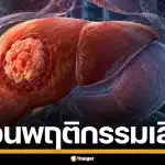 หมอแล็บแพนด้า เตือนพฤติกรรมเสี่ยง ไวรัสตับอักเสบบี ต้นเหตุ ตับแข็ง-มะเร็งตับ