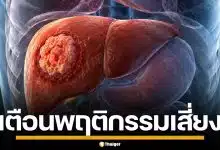 หมอแล็บแพนด้า เตือนพฤติกรรมเสี่ยง ไวรัสตับอักเสบบี ต้นเหตุ ตับแข็ง-มะเร็งตับ