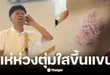 เสก โลโซ มีผื่นและตุ่มใสขึ้นแขน หวั่นเป็นงูสวัด