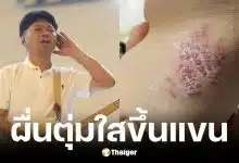 เสก โลโซ มีผื่นและตุ่มใสขึ้นแขน หวั่นเป็นงูสวัด
