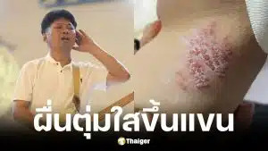 เสก โลโซ มีผื่นและตุ่มใสขึ้นแขน หวั่นเป็นงูสวัด