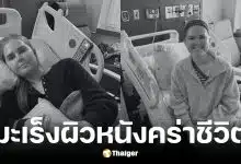 ดาวติ๊กต็อกวัย 25 ปีเสียชีวิตหลังสู้มะเร็งผิวหนัง