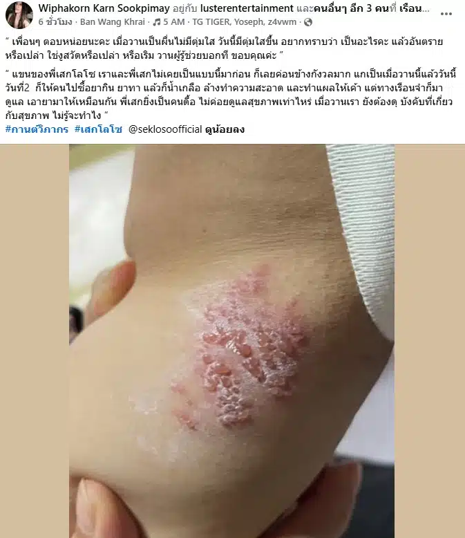 เสก โลโซ เป็นงูสวัด
