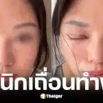 สาวจีนทำตาสองชั้นตาปิดไม่สนิท มีน้ำตาไหลตลอดเวลา