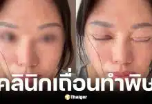 สาวจีนทำตาสองชั้นตาปิดไม่สนิท มีน้ำตาไหลตลอดเวลา