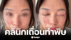 สาวจีนทำตาสองชั้นตาปิดไม่สนิท มีน้ำตาไหลตลอดเวลา