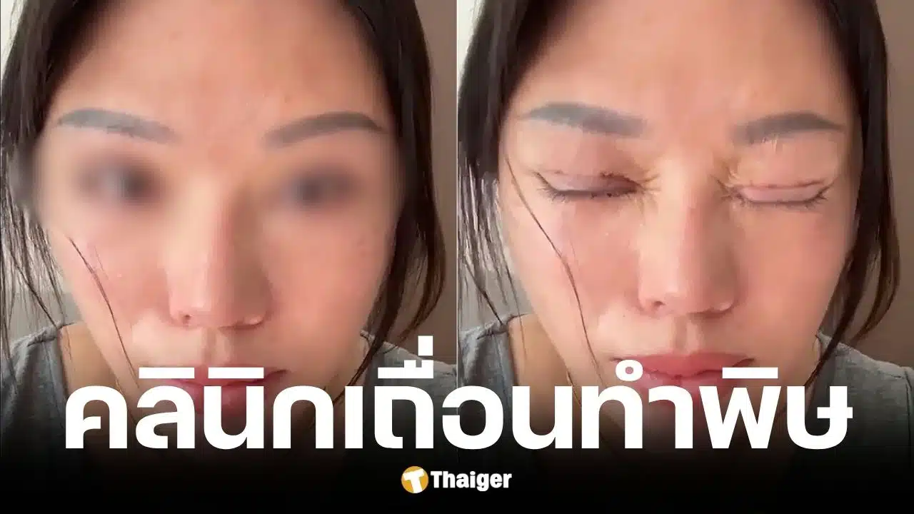 สาวจีนทำตาสองชั้นตาปิดไม่สนิท มีน้ำตาไหลตลอดเวลา
