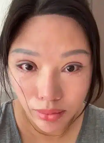 สาวจีนทำตาสองชั้นคลินิกเถื่อนจนตาปิดไม่สนิท-2