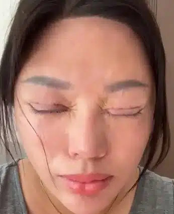 สาวจีนทำตาสองชั้นคลินิกเถื่อนจนตาปิดไม่สนิท-1