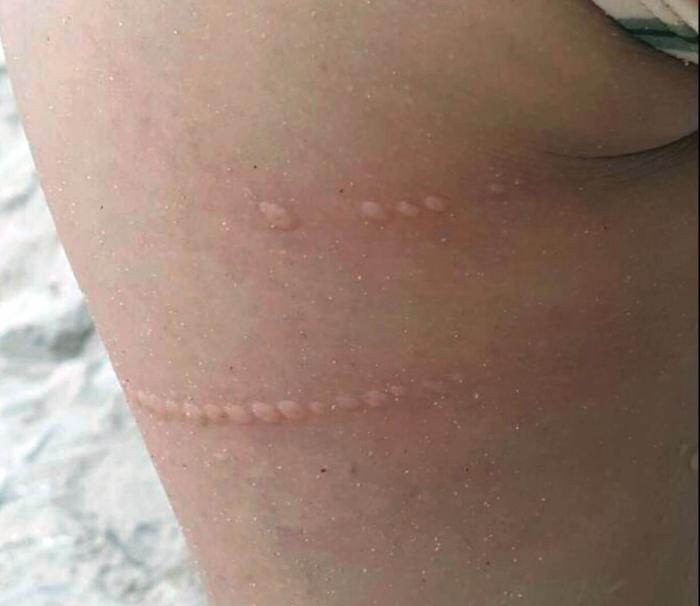 portuguese man of war sting scar