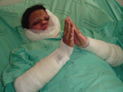 Burn victim Saijai slowly healing