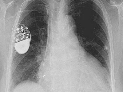 World News: Heartbeat could power pacemakers