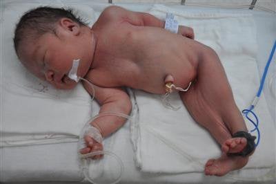 Phuket prays for baby with “mermaid syndrome’