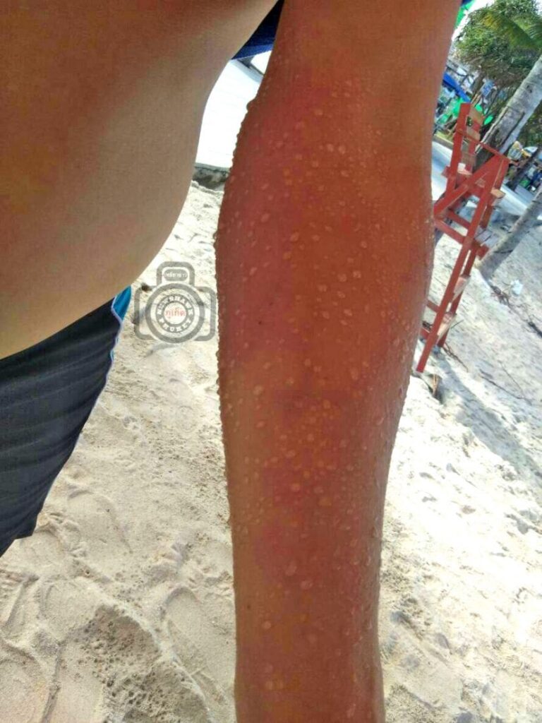 Swimmers stung by Bluebottles on Patong Beach | News by Thaiger