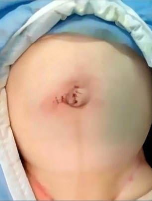 สยอง! พ่อเห็นลูกพุงป่อง ใช้คัตเตอร์เจาะหวังระบายลม ไส้ไหลทะลัก | The Thaiger