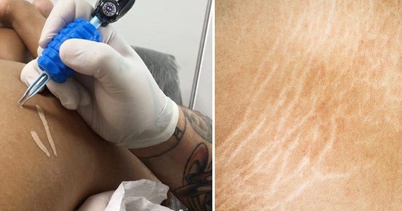 Tattoo Artist Hides Stretch Marks With SkinColored Ink  Before and After  Photos  Allure