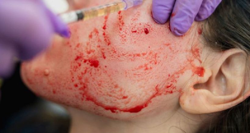 ผู้ป่วย 2 คนถูกวินิจฉัยติดเชื้อ HIV หลังทำ ‘vampire’ facial ที่สปา | The Thaiger