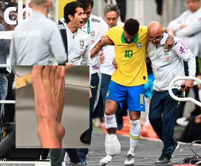 Neymar โพสต์ภาพตาตุ่มบวมเปร่ง หลังถูกเสียบในเกมพบกาตาร์ อาจชวด Copa America 2019 | The Thaiger